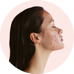 Лечение акне