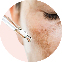 Лечение темных пятен